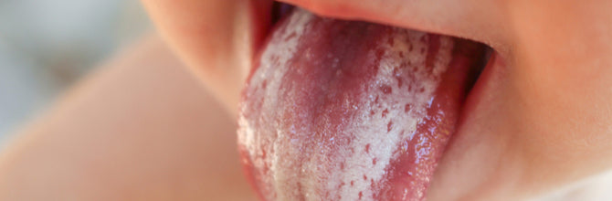 Oral Thrush Symptoms, Causes and Treatments Explained