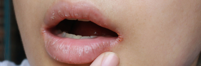  What is angular cheilitis?