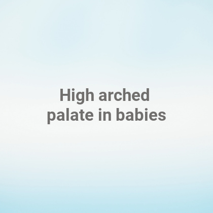 High arched palate in babies