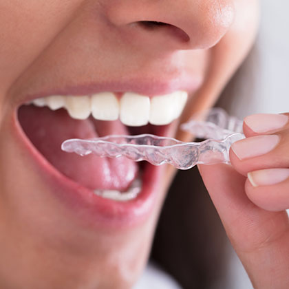 How to Stop Grinding Your Teeth: Causes and Treatments of Bruxism