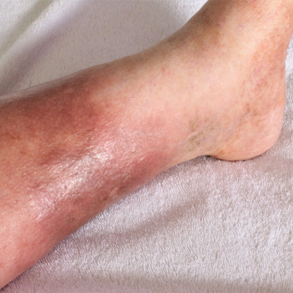 What is cellulitis?