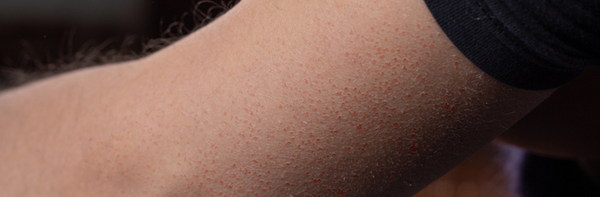 What is Keratosis pilaris?