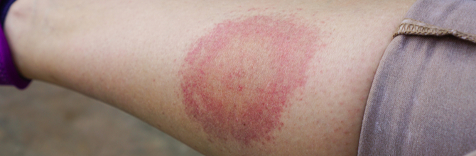  What is Lyme disease?