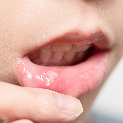  Mouth Ulcers: Symptoms and Signs