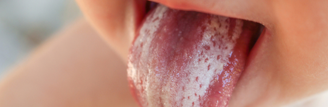 Oral Thrush Symptoms, Causes and Treatments Explained