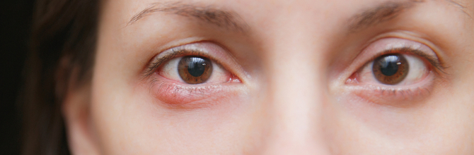 What Is a Stye and How Do I Treat One